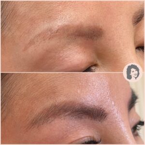 profhilo before and after